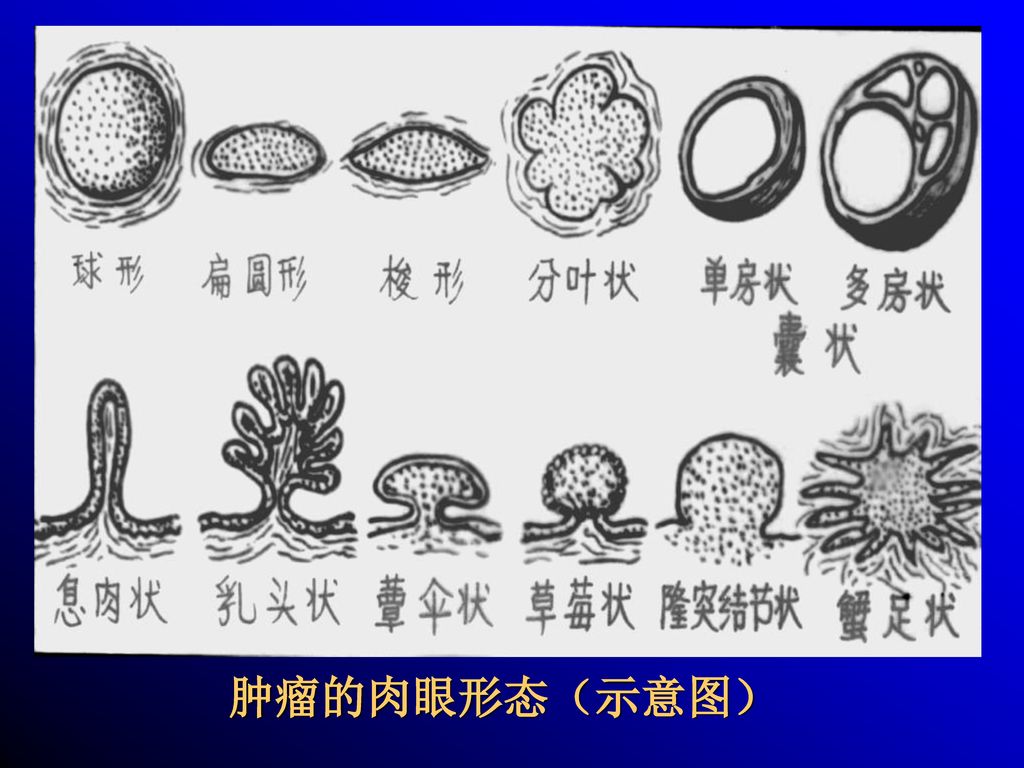 第五章 肿瘤(tumor,neoplasm)